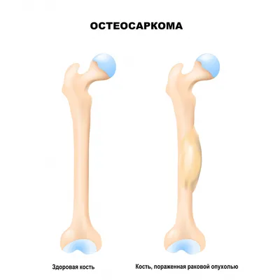 Саркома - причины появления, симптомы заболевания, диагностика и способы  лечения