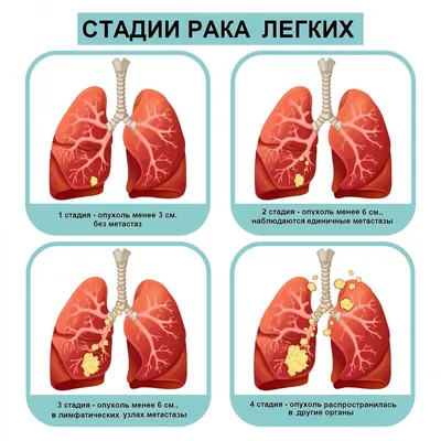 Рак легких - лечение, диагностика, симптомы, причины, прогноз