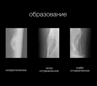 Опухоли костей (системный подход и дифференциальный диагноз)