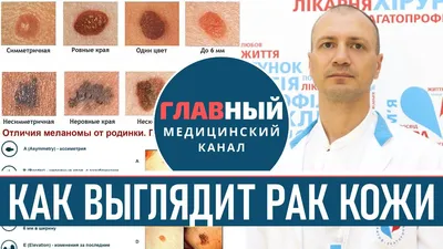 Как выглядит РАК КОЖИ (фото 1-8). Меланома, базалиома и плоскоклеточный рак  кожи - YouTube