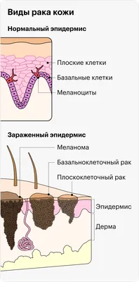 Как выглядит рак кожи и как его лечат