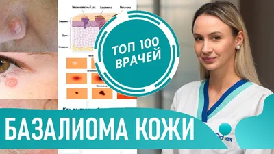 Как выглядит БАЗАЛИОМА (фото 1-7). Базальноклеточный рак кожи.  Базальноклеточная карцинома - YouTube