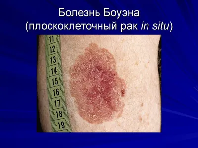 Typy, symptomy a léčba rakoviny kůže ve tvaru kůže. Introging Skin Cancer  Cancer Photo Trellium Cancer Cancer Mikroskopický vzor