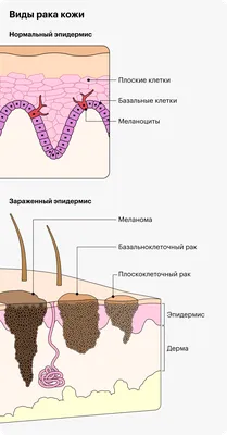 Как выглядит рак кожи и как его лечат