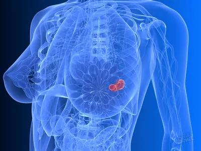 Рак груди: причины, симптомы, профилактика
