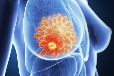 Признаки рака груди, которые не принимают всерьез: на что обратить внимание