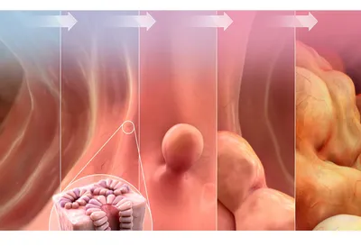 Рак кишечника «помолодел» на шесть лет — Naked Science