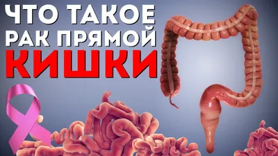 Что такое рак прямой кишки? | Болезнь от первого лица | Просто об онкологии  - YouTube