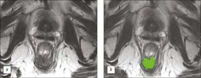 МРТ-оценка результата неоадъювантной химиолучевой терапии у больной раком  прямой кишки, дополненная текстурным анализом Т2-ВИ опухоли (клинический  случай) - Дайнеко - Digital Diagnostics
