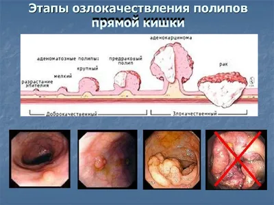 7-13 ноября - неделя профилактики рака толстой кишки