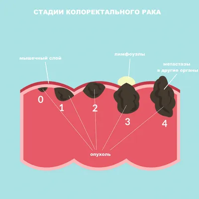 Рак кишечника - причины появления, симптомы заболевания, диагностика и  способы лечения