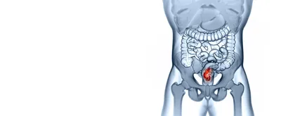 Рак прямой кишки – диагностика, симптомы, лечение в ФНКЦ ФМБА России