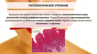 Онколог Александр Жуковец: 50% людей с раком полости рта на работу ходят, а  к врачам – нет - KP.RU