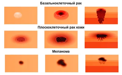 Рак кожи: признаки, стадии, диагностика и лечение. Онкология