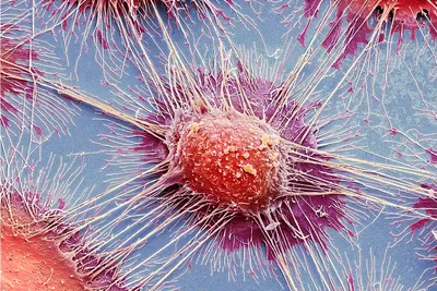 Рак под микроскопом: современные технологии помогают поставить правильный  диагноз