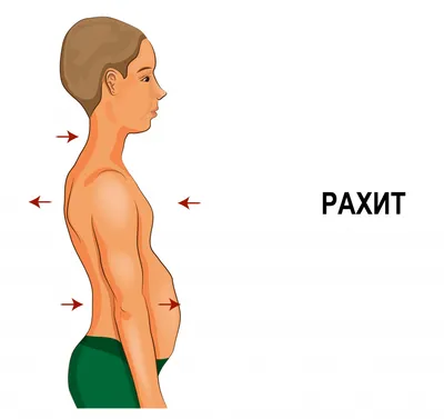 Рахит фотографии
