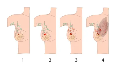 Первые симптомы рака груди о которых должна знать каждая женщина - КГБУЗ  Горбольница №12