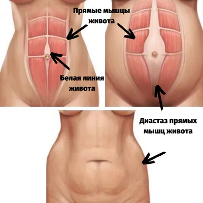 Диастаз прямых мышц живота: что такое, причины, как определить, как убрать,  как лечить, профилактика