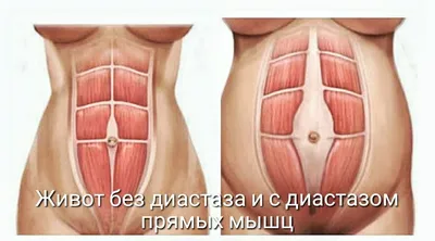 Беременность и расхождение мышц живота | Rehab Insider | Дзен