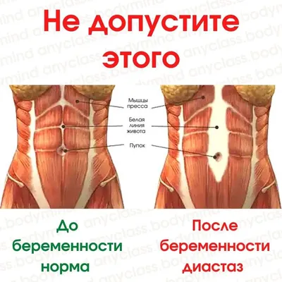 ПерсонА» ems-studia - Диастаз прямых мышц живота — довольно  распространенная проблема, особенно актуальная после родов. ❗️Рассмотрим,  что такое диастаз, как с ним бороться и почему с помощью EMS тренировок  можно быстрее от