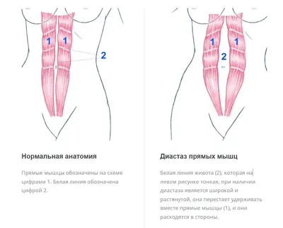 ДИАСТАЗ ПРЯМЫХ МЫШЦ ЖИВОТА. ЛФК ПРИ ДИАСТАЗЕ | ВКонтакте