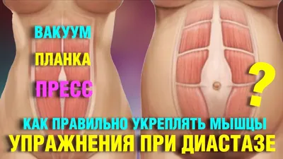 Диастаз мышц: что это такое и как с этим бороться