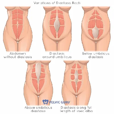 Лечение диастаза прямых мышц живота в Киеве | МЦ Лелека