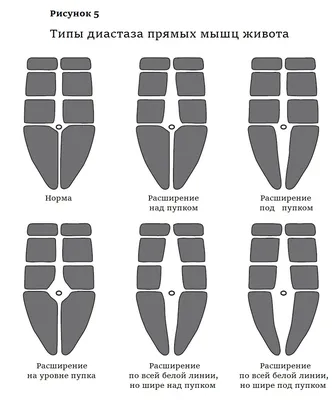 Как убрать диастаз — бесплатная операция по ОМС