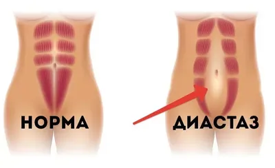 ПерсонА» ems-studia - Диастаз прямых мышц живота — довольно  распространенная проблема, особенно актуальная после родов. ❗️Рассмотрим,  что такое диастаз, как с ним бороться и почему с помощью EMS тренировок  можно быстрее от