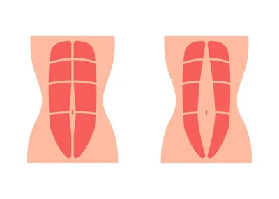Диастаз - признаки и причины