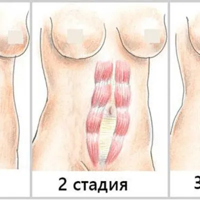 Диастаз прямых мышц живота: причины, симптомы и лечение в статье проктолога  Агапов М. А.