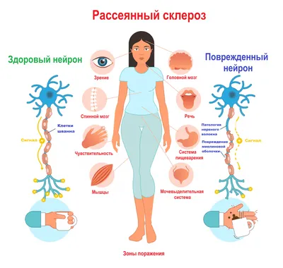 Рассеянный склероз - причины появления, симптомы заболевания, диагностика и  способы лечения