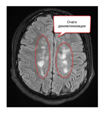 МРТ при рассеянном склерозе в Московской клинике рассеянного склероза