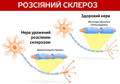 Врач с диагнозом «рассеянный склероз»