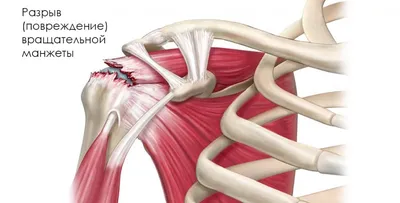 Разрыв (повреждение) вращательной манжеты плечевого сустава - диагностика и  лечение в СПб, цена