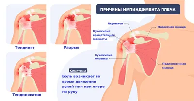 Боль в плече - причины появления, симптомы заболевания, диагностика и  способы лечения