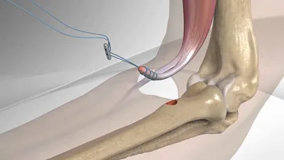 Лечение повреждения дистального сухожилия двуглавой мышцы Киев, Украина -  Долгополов А. В.