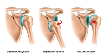 Лечение травм плечевого сустава