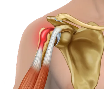 Лечение разрывов сухожилия бицепса