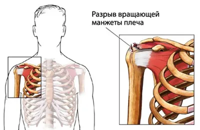 Как исправить круглые плечи: гид по коррекции осанки - Лайфхакер