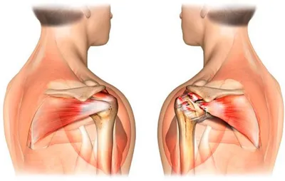 Упражнения по укреплению мышц и сухожилий вращательной манжеты — Травмаорто