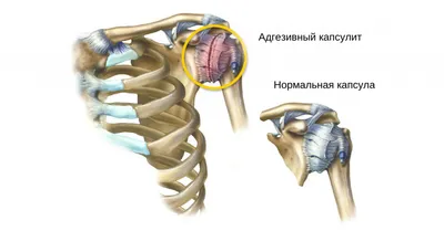 Растяжение мышц спины: симптомы и лечение