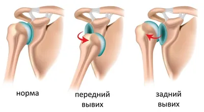 Вывих плеча — статья о травме плечевого сустава и лечении