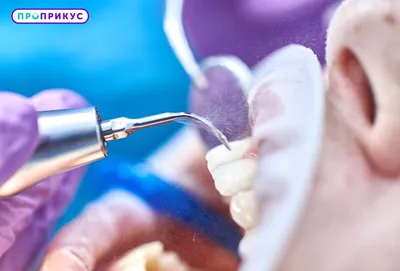 Стоматит после удаления зуба: симптомы, причины и терапия