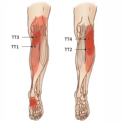 Икроножная мышца: анатомия, триггерные точки, причины боли