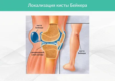 Ник Уолкер сообщил, что перенес разрыв икроножной мышцы первой степени  Новости бодибилдинга на Амбал.ру