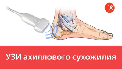 Киста Бейкера — 24Radiology.ru