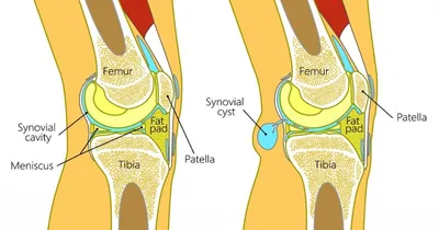 Разрыв ахиллова сухожилия ✦ Перевозка больных Киев ✦ Med103