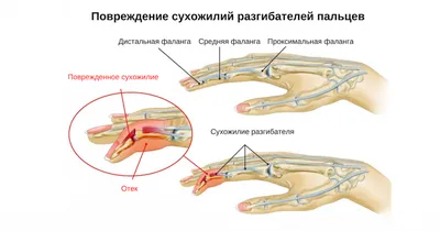 Сухожилия четырехглавой мышцы бедра (прямой мышцы): тенденит, растяжения,  разрывы – Лечение и восстановление – Отделение травматологии –  Государственная больница НКЦ №2 (ЦКБ РАН)