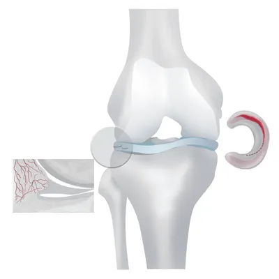 Лечение Повреждение мениска - Ортопедия Руслана Сергиенко